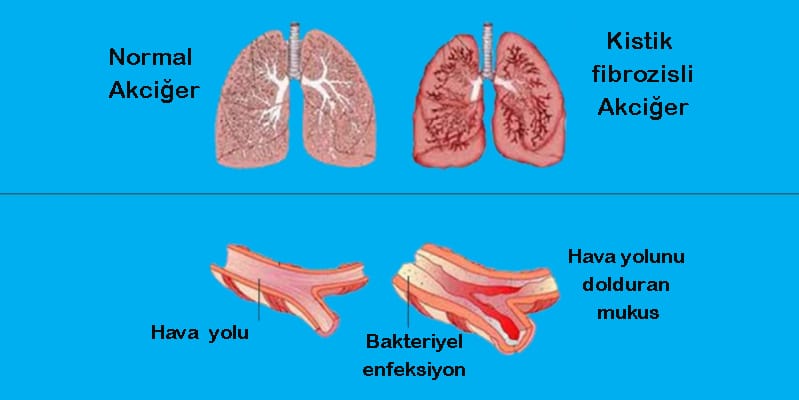 kistik-fibrozis-cystic-fibrosis-4